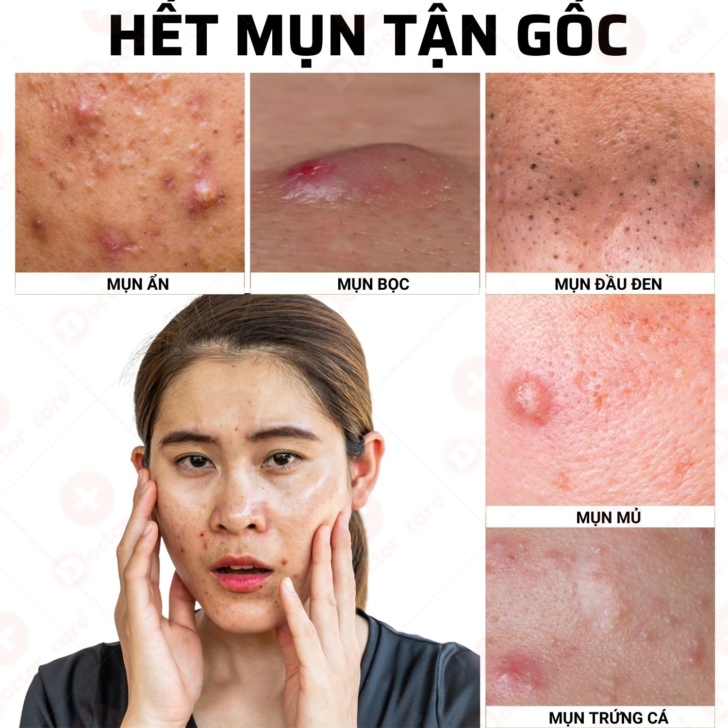 Serum Tri Mụn thâm Doctor Care Acnes Elimination 20ml