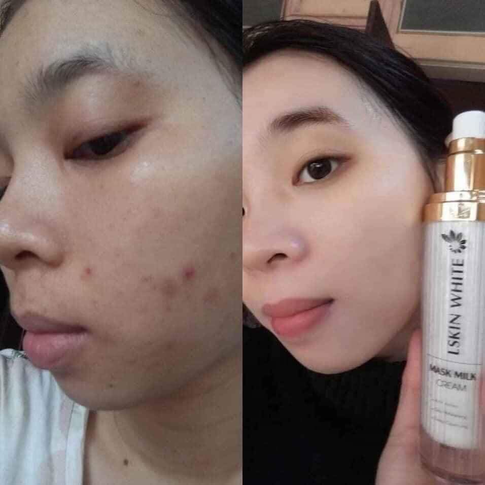 Ủ Trắng Da Kén Tằm chính hãng