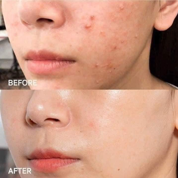 Tinh chất giảm mụn SVR Sebiaclear Serum 30ml