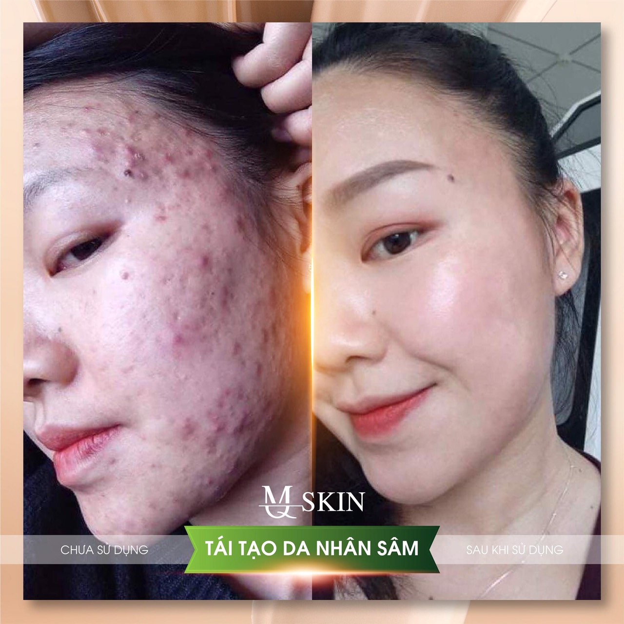 [FREESHIP + QUÀ TẶNG] - SERUM TÁI TẠO THAY DA NHÂN SÂM MQSKIN (HÀNG CHÍNH HÃNG)