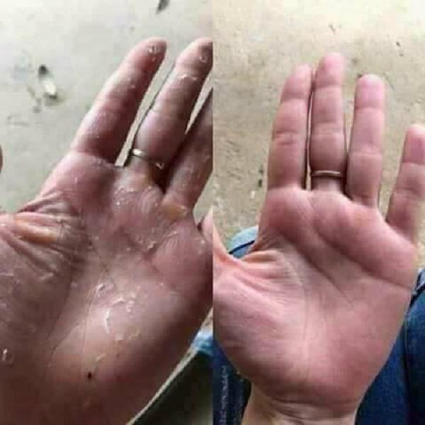 Cao lá trị nút nẻ
