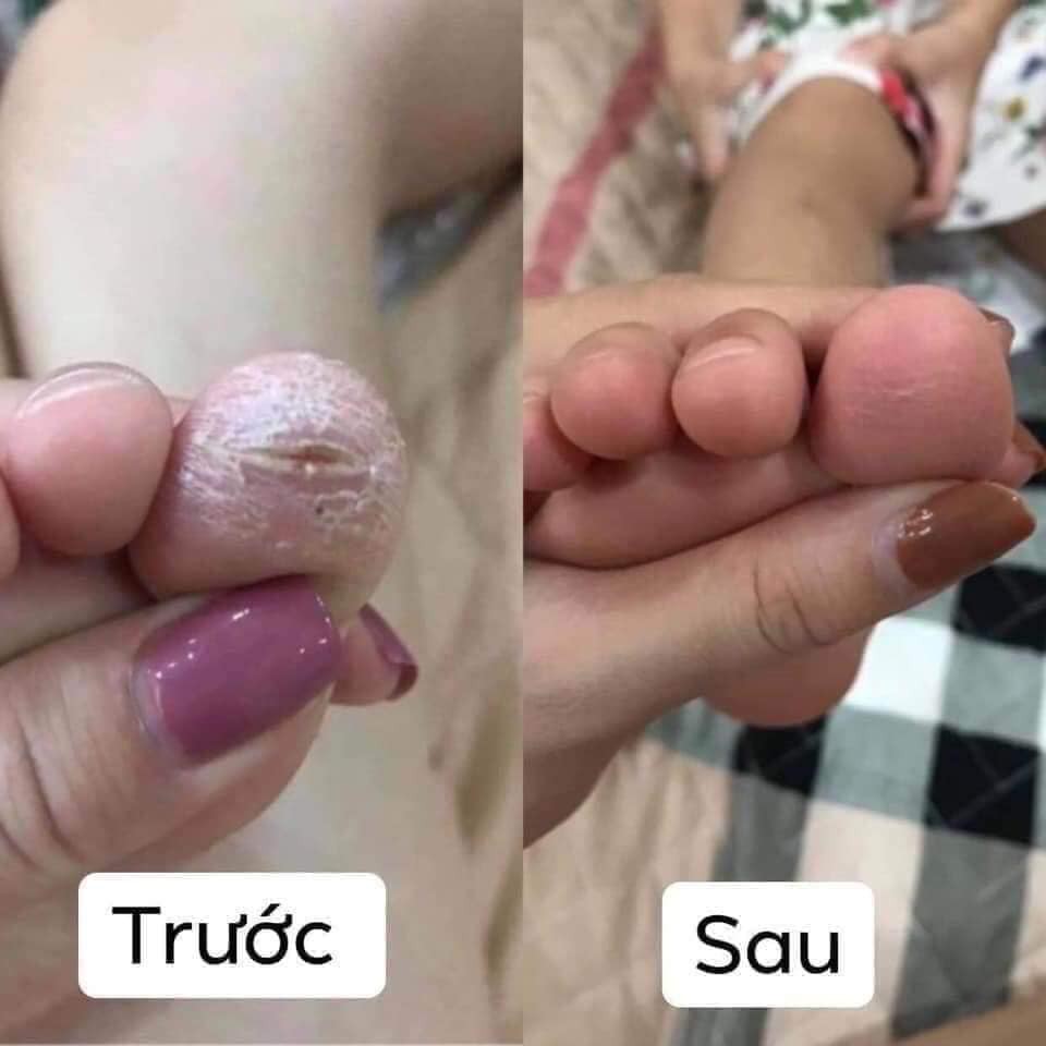 Kem Bôi Nấm Ngứa, Á Sừng
