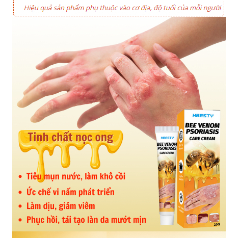 Kem bôi nọc ong hbesty, giảm tổ đỉa, á sưng, eczema