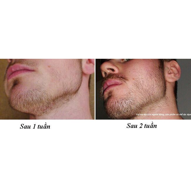 [HCM]Minoxidil 5% Bọt Mọc Râu Nhanh + Biotin 10000mcg