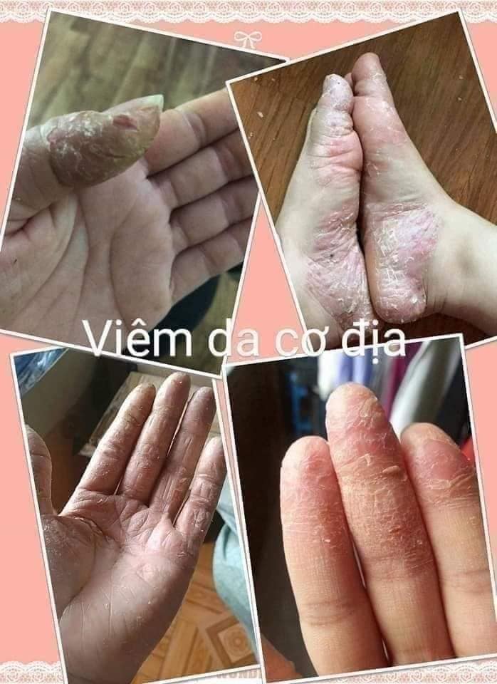 Viêm da,ngoài da Trần Kim Huyền