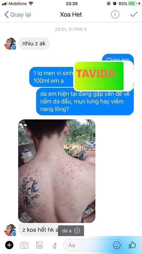 Mụn Lưng Mụn Ngực Men Vi Sinh Tavida