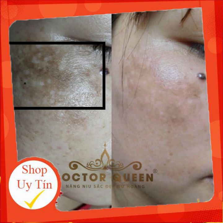 Kem Nám Doctor Queen-🔥𝐍𝐄𝐖🔥- (Ngừa Các Loại Nám,Sạm Da,Tàn Nhang,Làm Sáng Da,Đều Màu Da.,,)