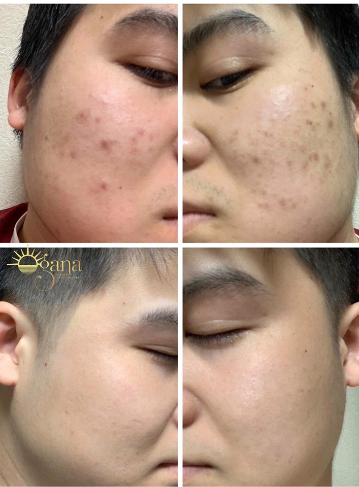 [HCM]SERUM OGANA TRỊ MỤN