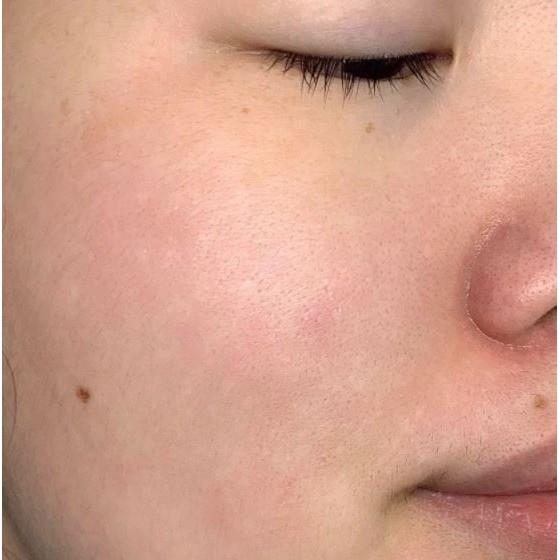 ▤✗  Sữa Rửa Mặt Dạng Gel Eucerin Acne-Oil Control Pro Acne Solution Cleansing Gel