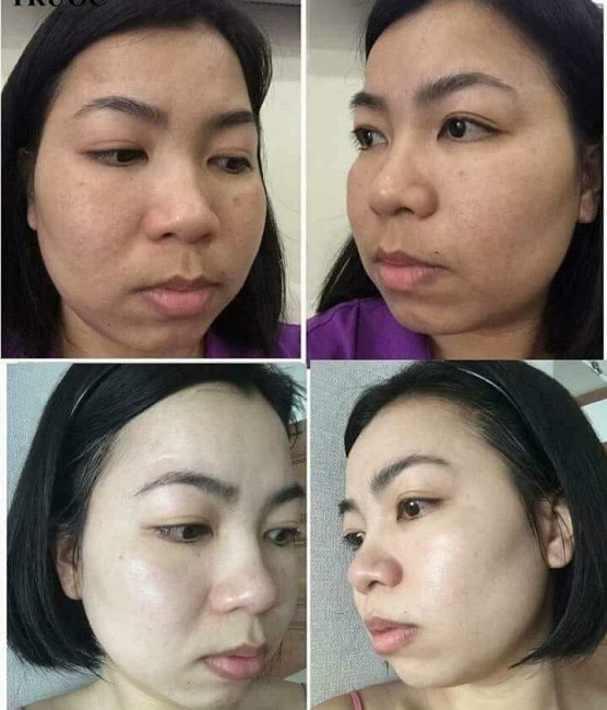 [HCM]KEM FACE NÁM CAO CẤP SWHITE