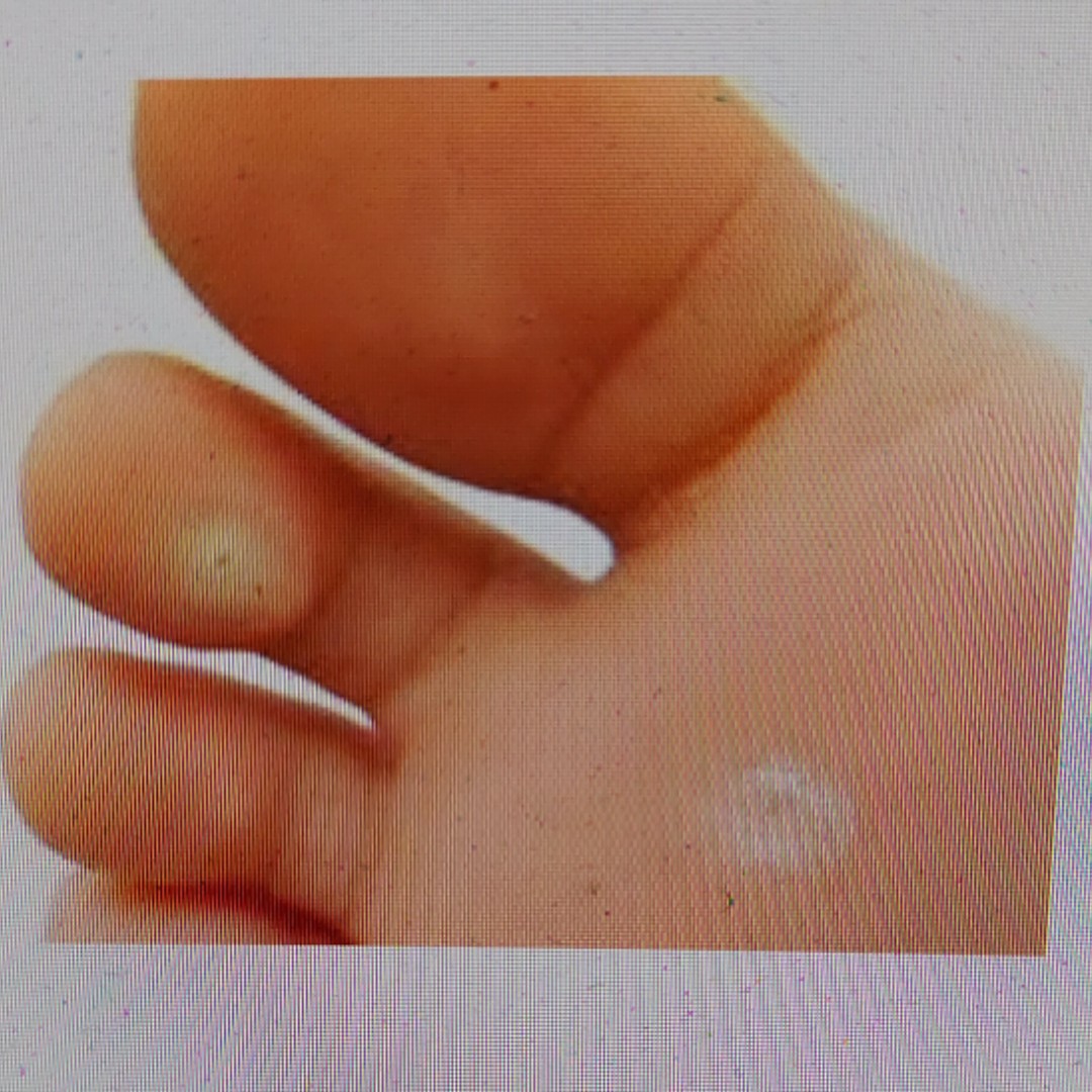 Hết mụn cóc, mụn cơm, vết chai sần mắt cá chân lọ dung dịch15ml