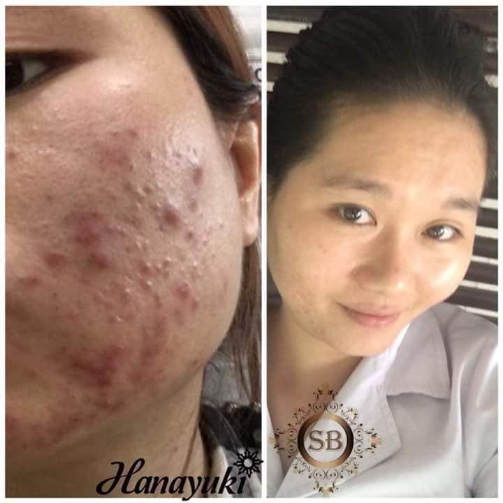 [HCM]Serum Mụn Hanayuki