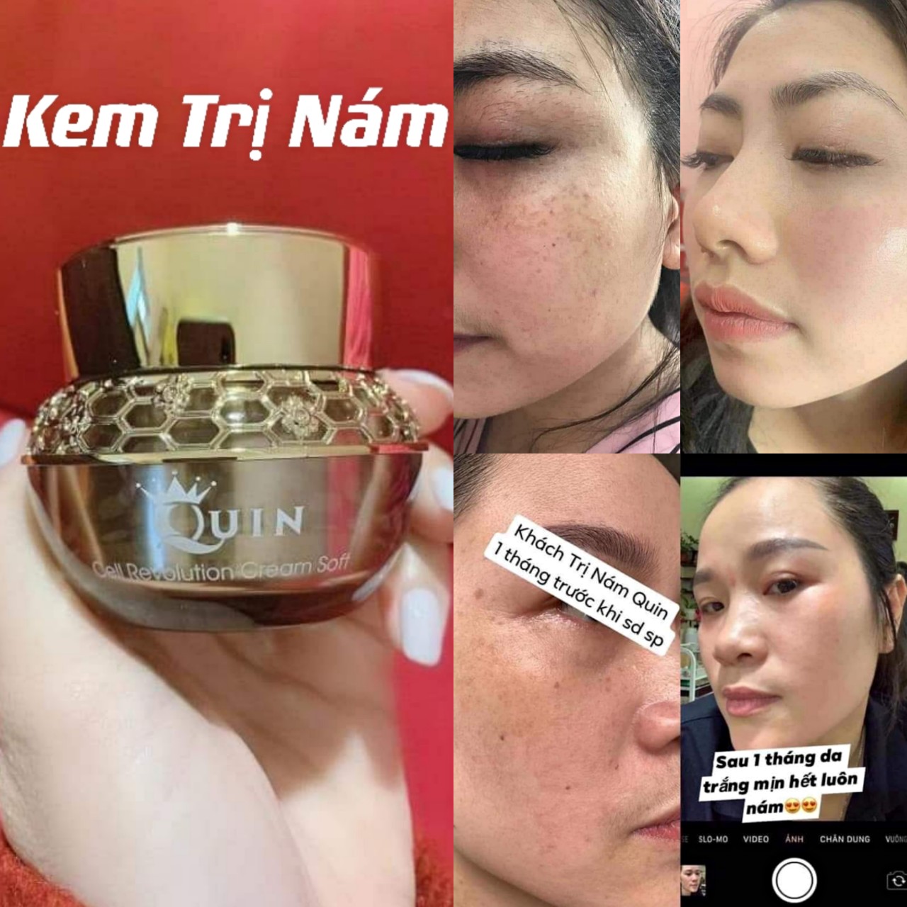 [ Bán chạy năm 2021] [HÀNG CAO CẤP ] KEM MỜ NÁM QUIN PHIÊN BẢN MỚI 2021