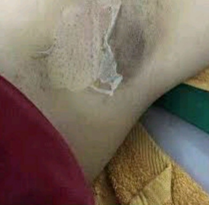 [HCM]PEEL LỘT TRẮNG DA NÁCH. HẾT THÂM(Tặng kem dưỡng)