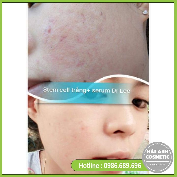 Kem Mụn Stemcell 2 💕 FREESHIP 💕Stem Cell 2 - Stemcell Trắng