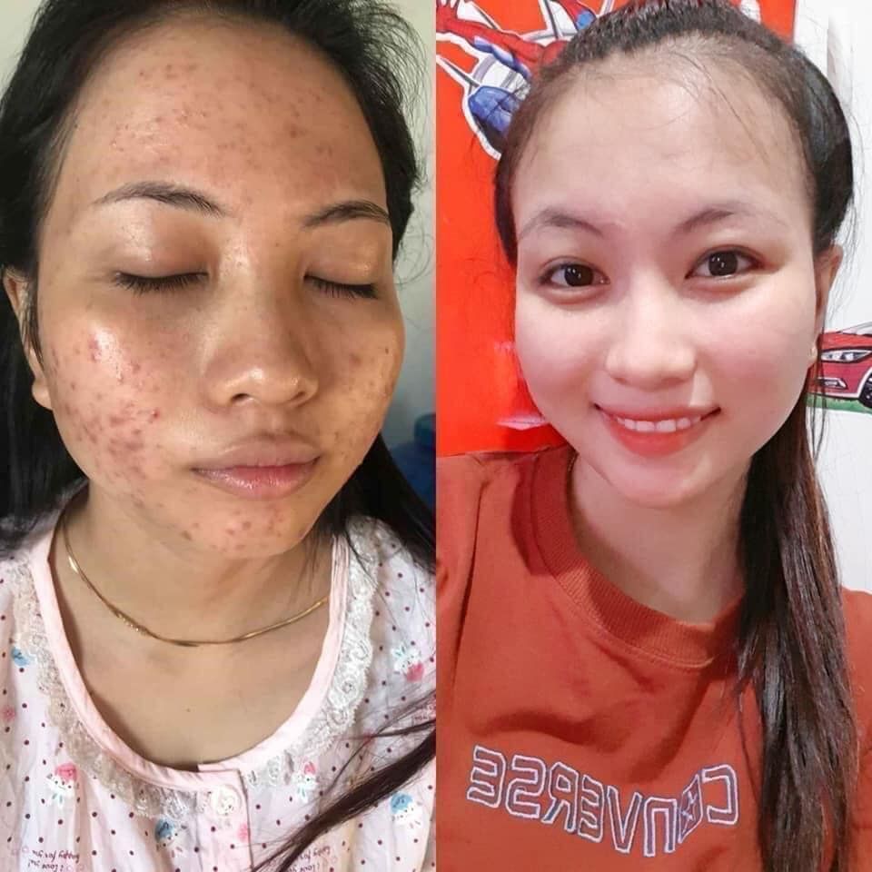[HCM]Cao m ụn sâm đỏ 15g - Cao sâm đỏ - Cao tri. mun - Kem tri. mun