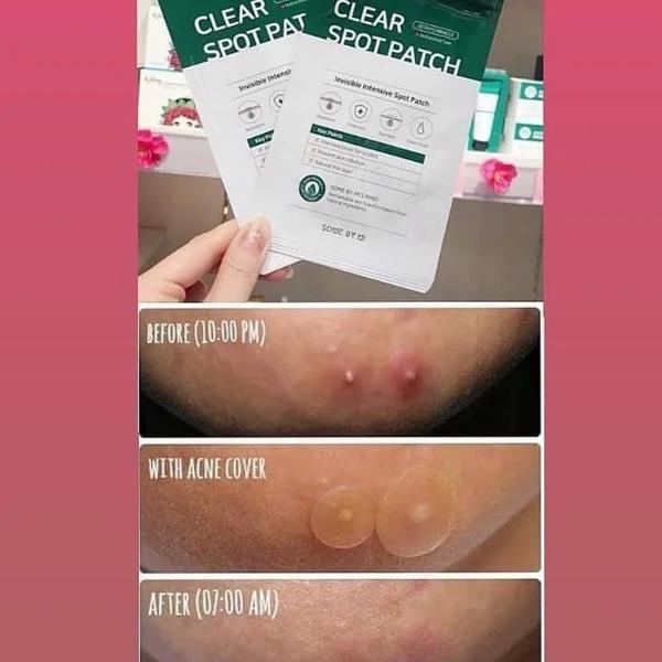 Combo 3 Miếng Dán Mụn Some By Mi Clear Spot Patch (Set 18 miếng) x 3