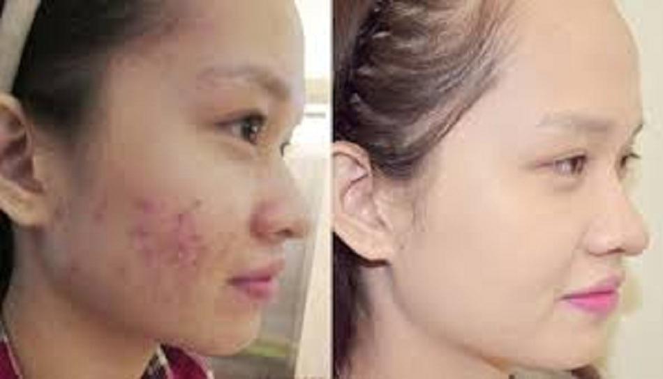 KEM MỤN THẢO DƯỢC MẸ KEN-30ml