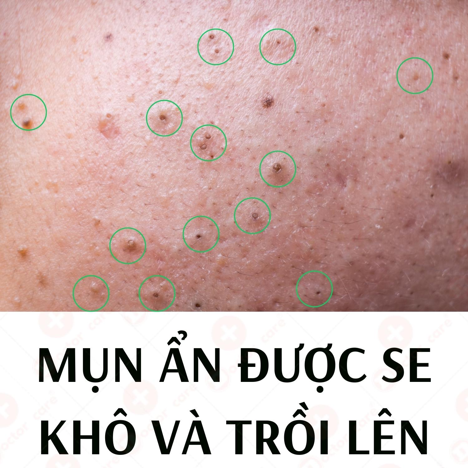 Serum Tri Mụn thâm Doctor Care Acnes Elimination 20ml