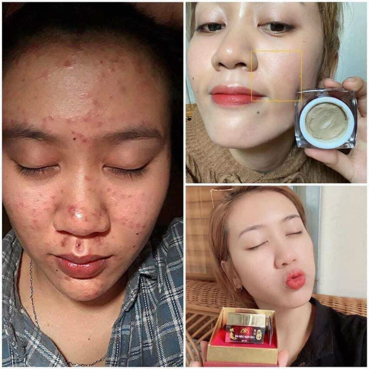 Cao Mụn Sâm Đỏ 36 Vị Meea Organic Giảm Mụn Mờ Thâm 15g