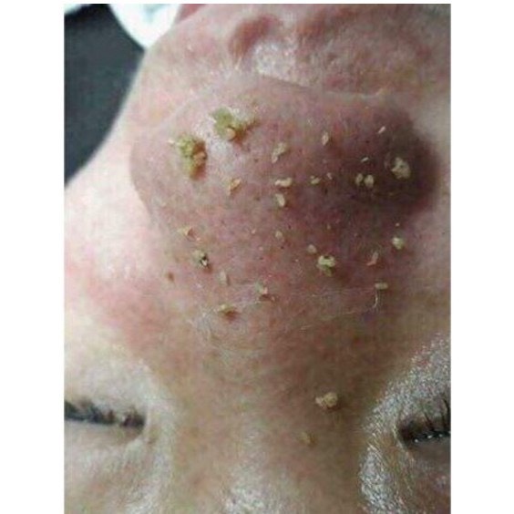 Ủ Mụn Youngerc, Ủ Mụn Cám Lột Sạch Mụn Trên Da Mặt Mũi.