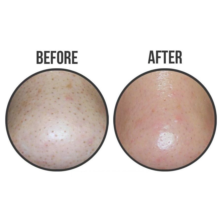 Miếng lột mụn đầu đen CIRACLE Good Bye Blackhead 5ml​ Hàn Quốc﻿ (1 miếng)