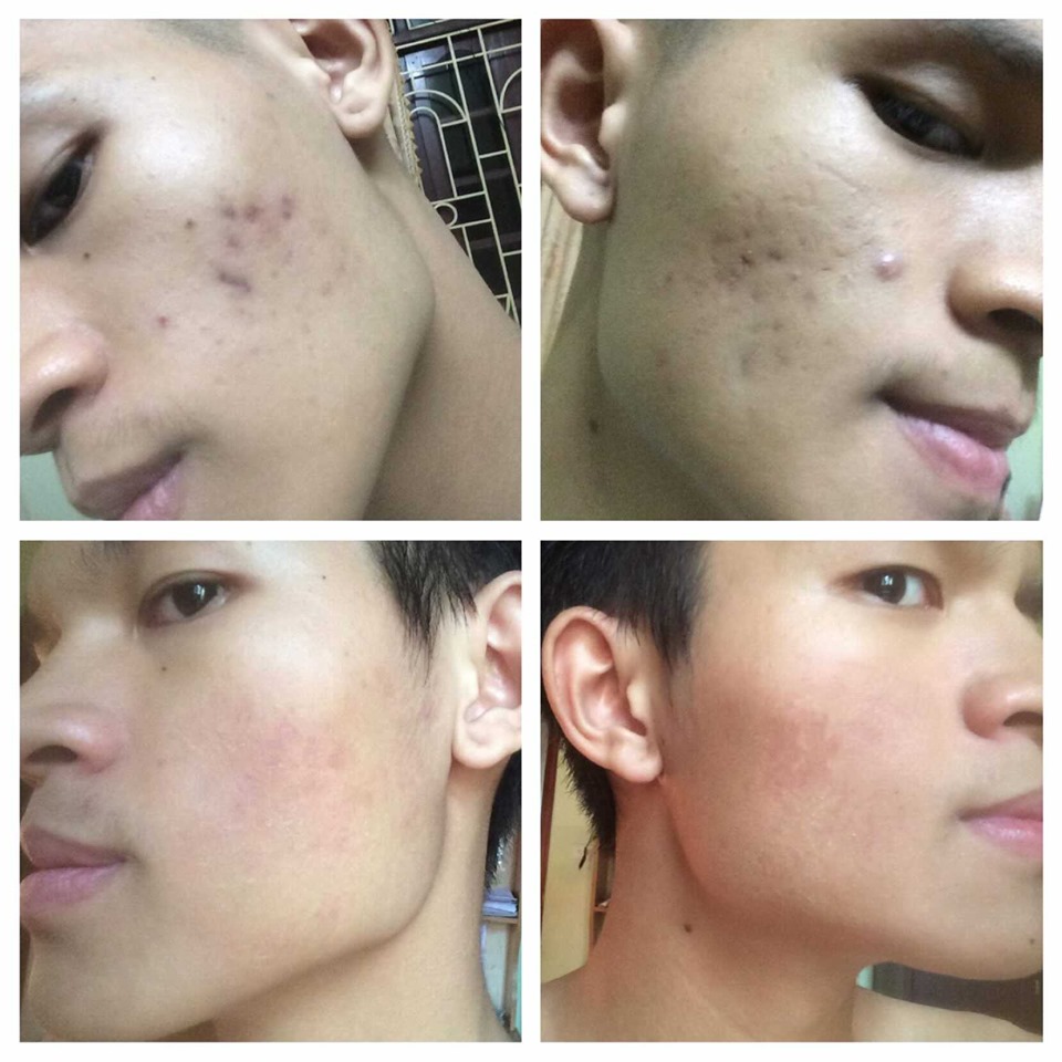 THẢO DƯỢC MT SẠCH MỤN THÂM RỖ (100ml)