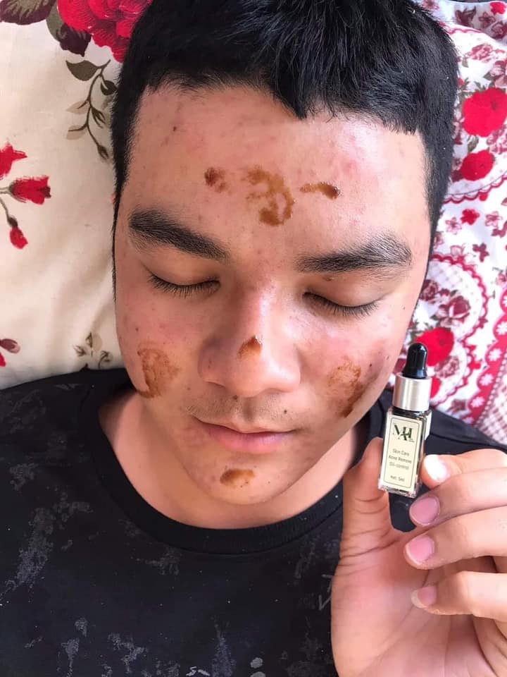 [HCM][CHÍNH HÃNG] SERUM MỤN DR Mai nguyên chất + QUÀ