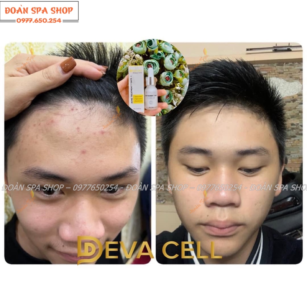 Vi sinh mụn hạt DevaCell - Vi sinh mụn Deva Cell