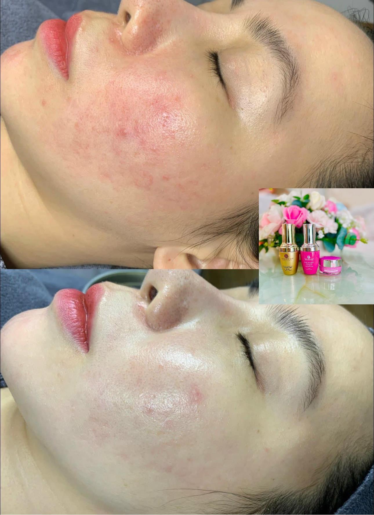 KEM FACE NANO DƯỠNG TRẮNG DA MỜ THÂM. THẢO MỘC SPA