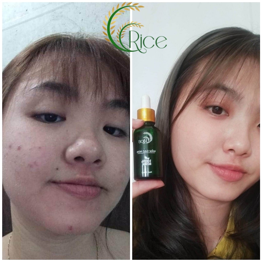 [KÈM QUÀ TẶNG] SERUM RICE MẦM GẠO NON XÓA MỤN MỜ THÂM NÁM SẠM DA