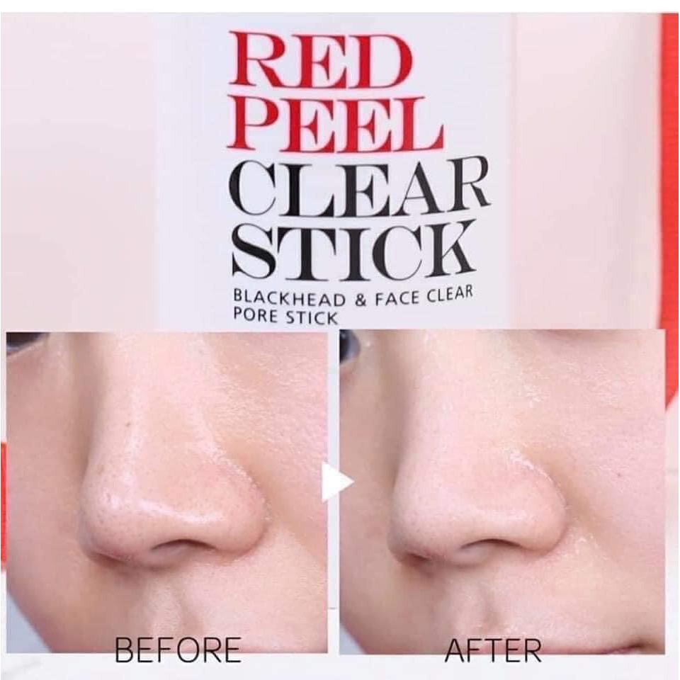 Serum Red Peel Tingle Thay Da Phục Hồi Sinh Học 35ml