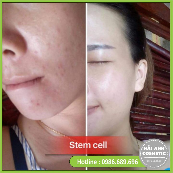 Kem Mụn Stemcell 2 💕 FREESHIP 💕Stem Cell 2 - Stemcell Trắng