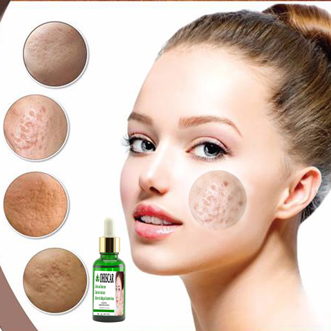 Serum Sẹo Rổ OHISCAR