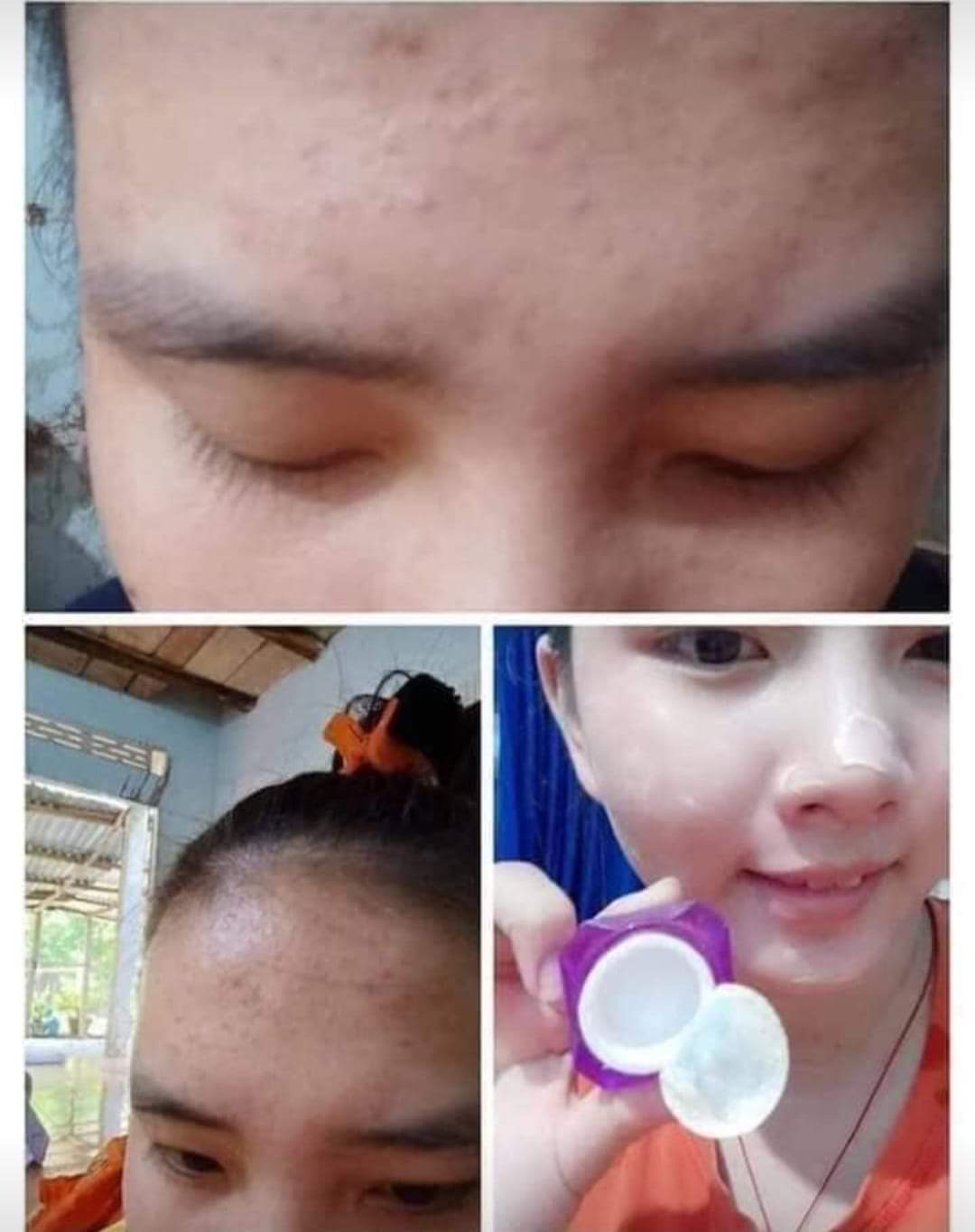 Kem mụn trắng da 2c chính hãng