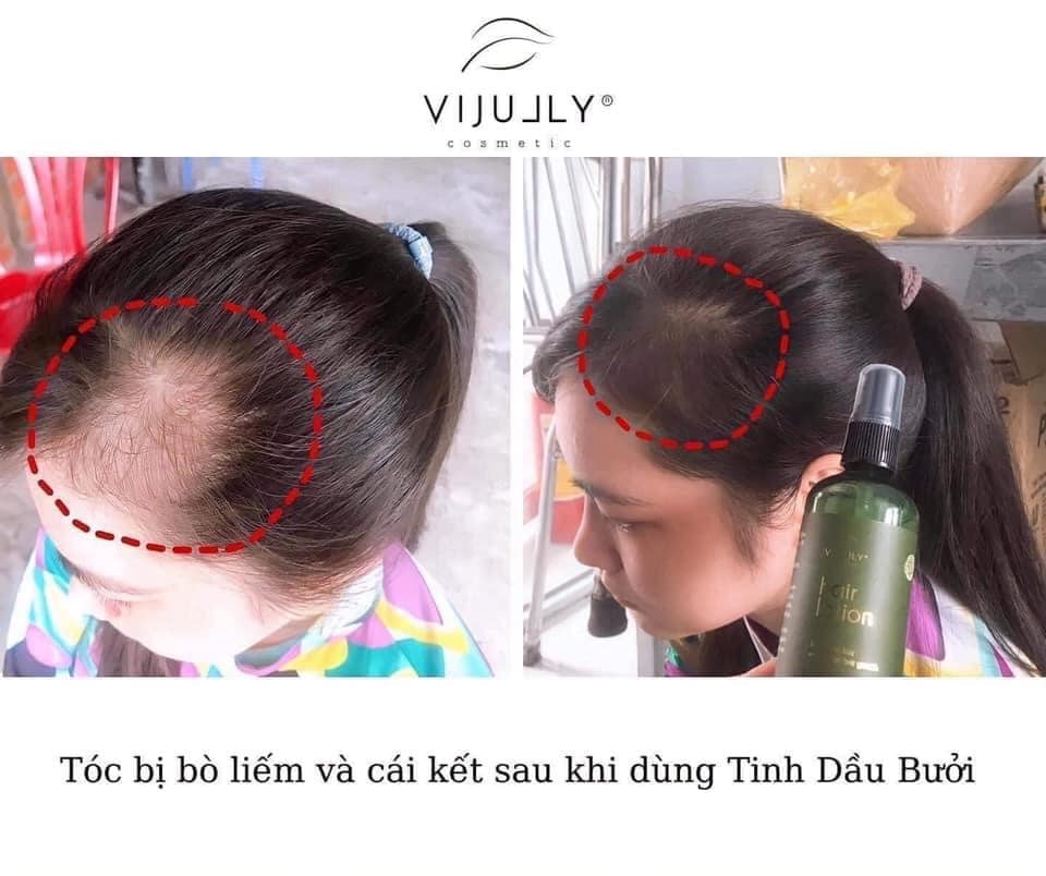 TINH DẦU XỊT BƯỞI KÍCH THÍCH MỌC TÓC VIJULY