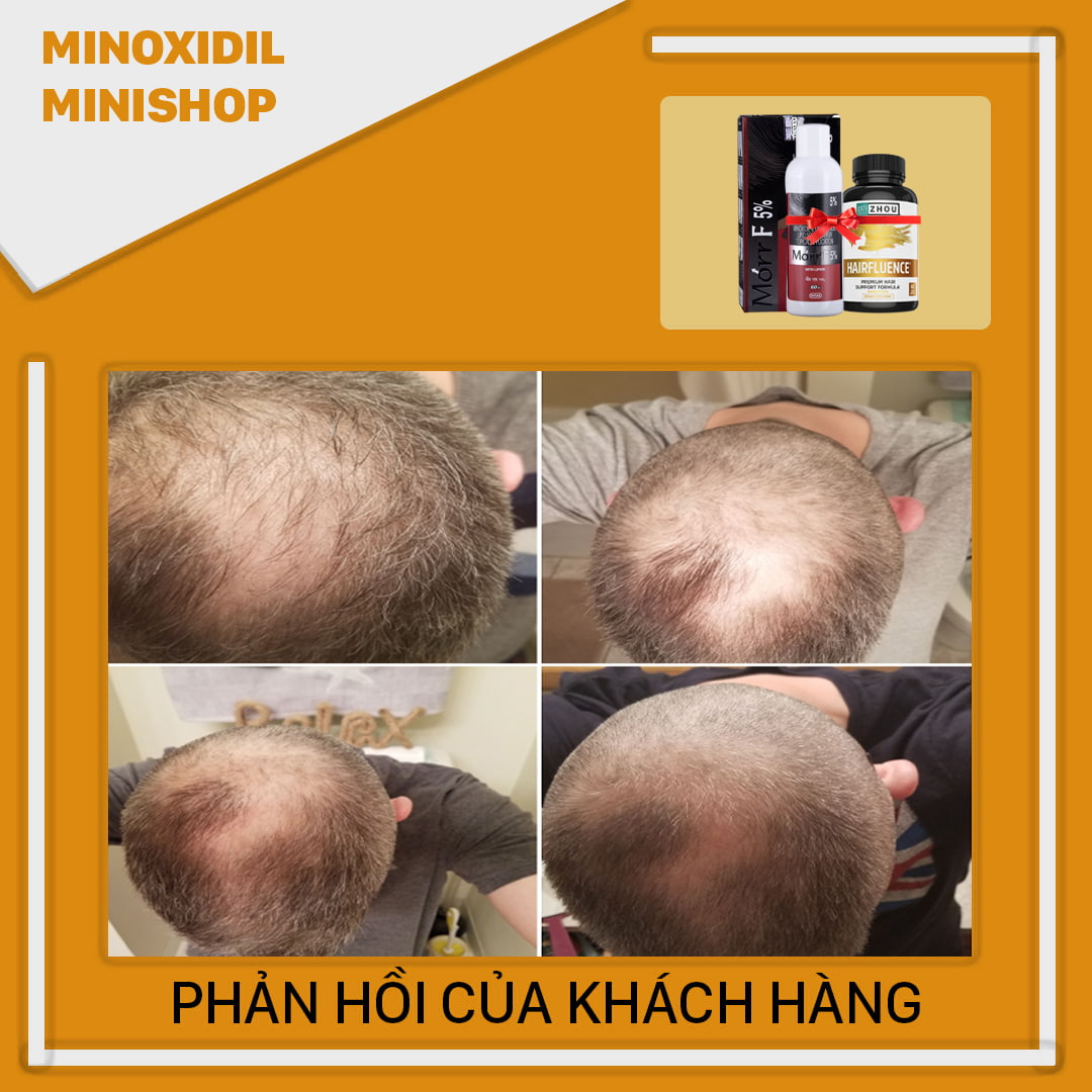 Combo Mọc Tóc Hói Morr F5 + HairFluence
