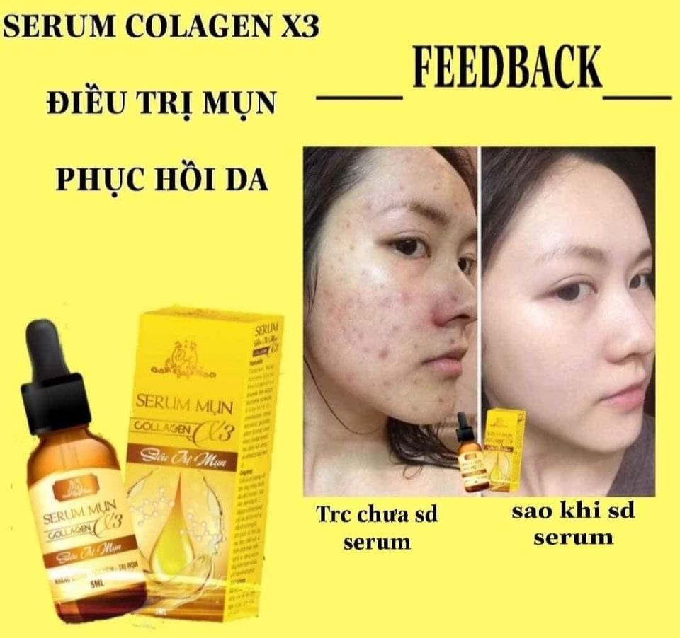 [HCM]Serum Mụn Collagen X3