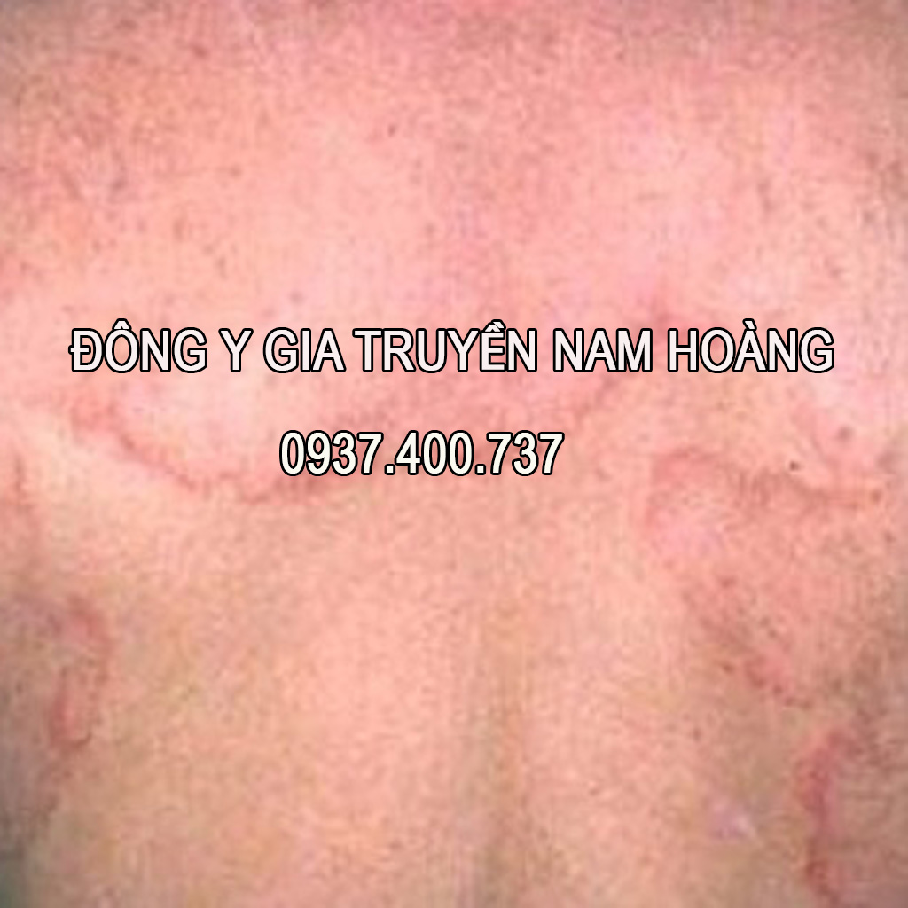 Thuốc Đặc Trị Bệnh Lang Ben Nam Hoàng