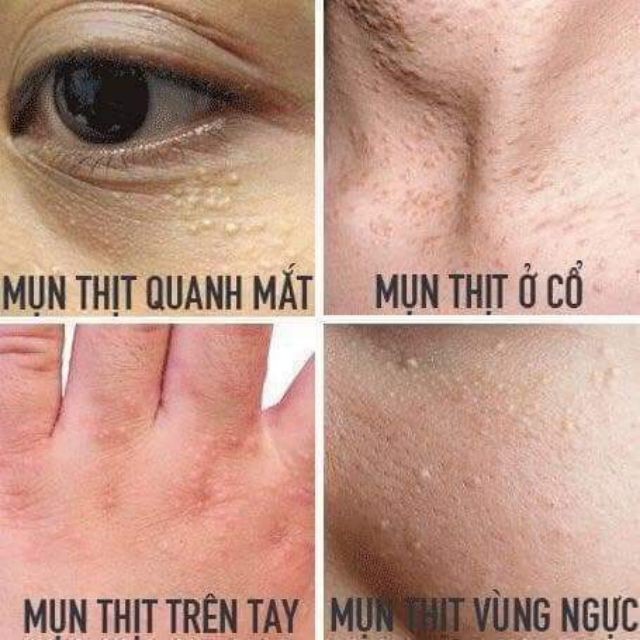 Kem Xóa Mụn Thịt Mắt Giảm Thâm Hết Bọng Mắt