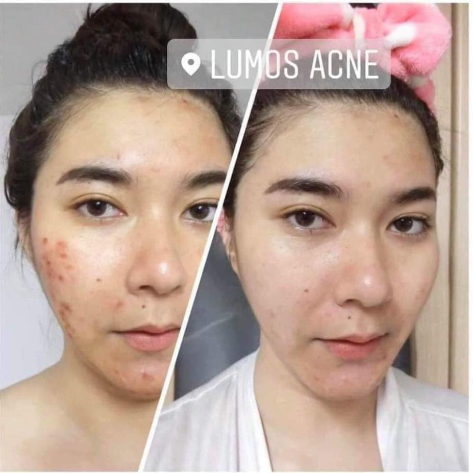 [mẫu mới 2021] Serum Mụn Dưỡng Trắng Da Lumos Acne Cao Cấp