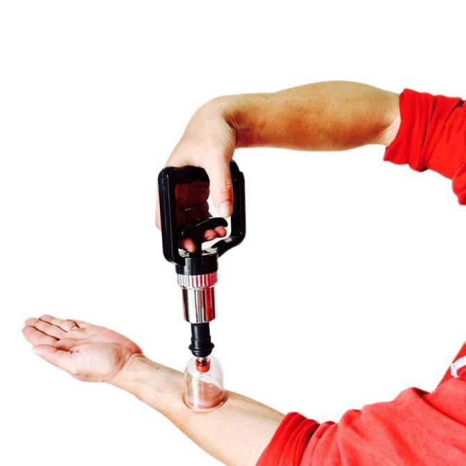 Bộ Giác Hơi Không Dùng Lửa YGH02