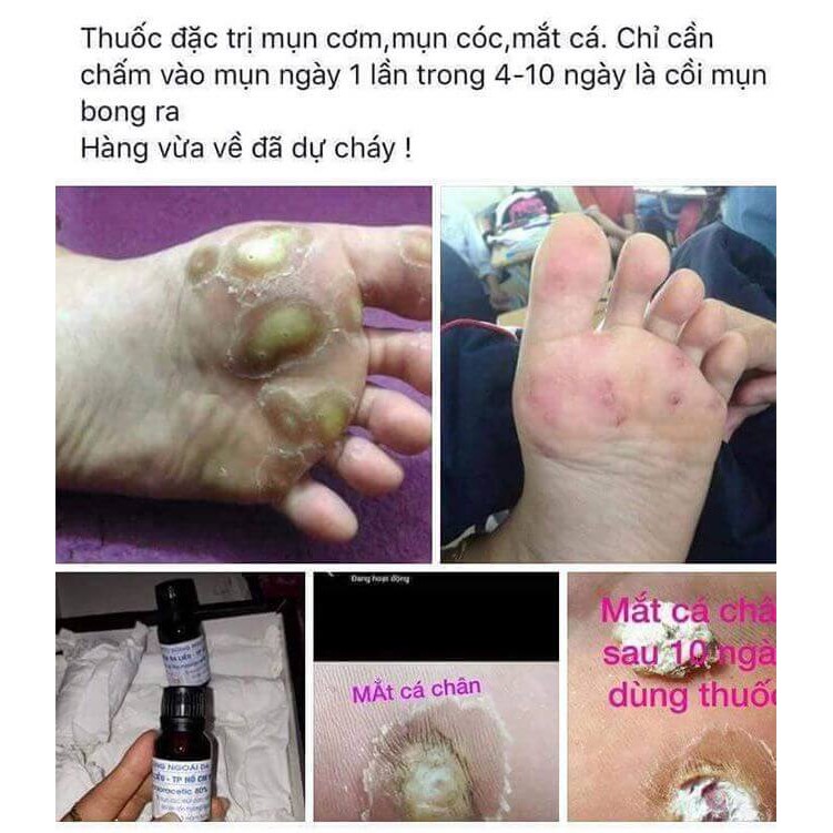 Loại bỏ mụn cóc, mụn cơm, mắt cá chân, mụn thịt, nốt chai sần