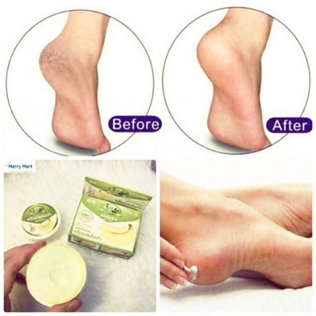 (giá sỉ) (giá sỉ ) Kem nứt gót chân The banana Thái Lan 30ml.