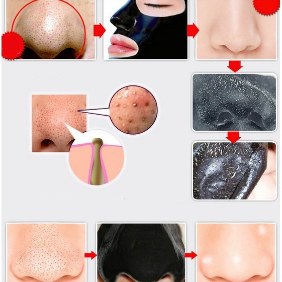Gel Lột Mụn Than Hoạt Tính