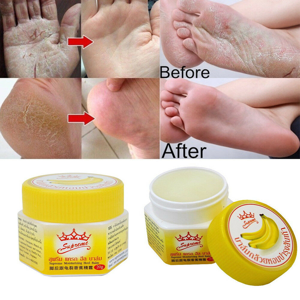 [HCM]KEM CẢI THIỆN NỨT GÓT  CHÂN BANANA