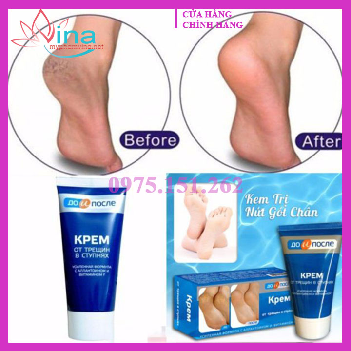 KEM NỨT GÓT CHÂN KPEM 50ML - NGA