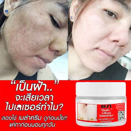 Kem BEZY Bong Da Mặt Xóa Thâm Nám Sạm Trắng Da ( Bong nhanh sau 5 ngày)