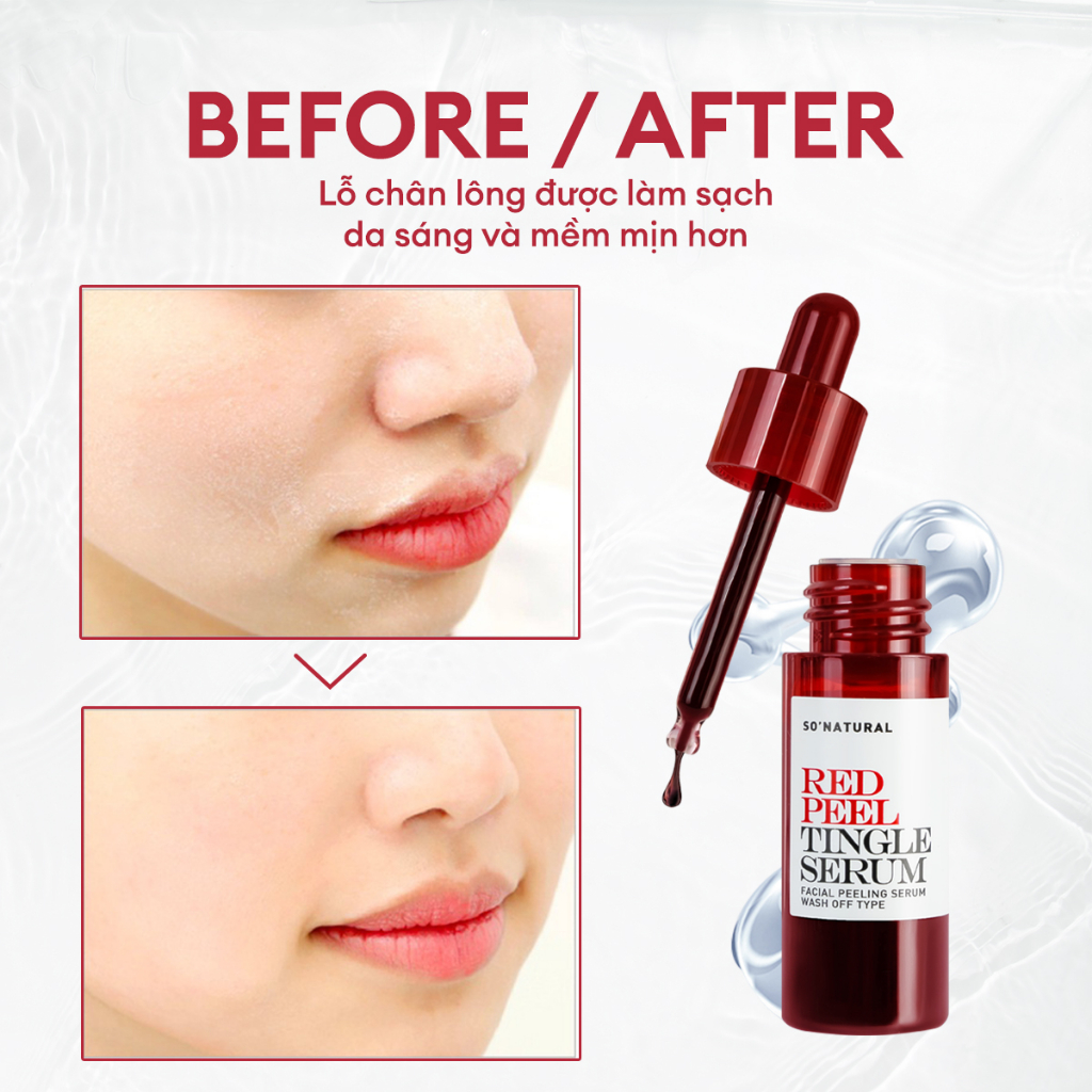 Tinh Chất Red Peel Tingle Serum 11ml, Tinh Chất Tẩy Tế Bào Chết Peel Da Sinh Học