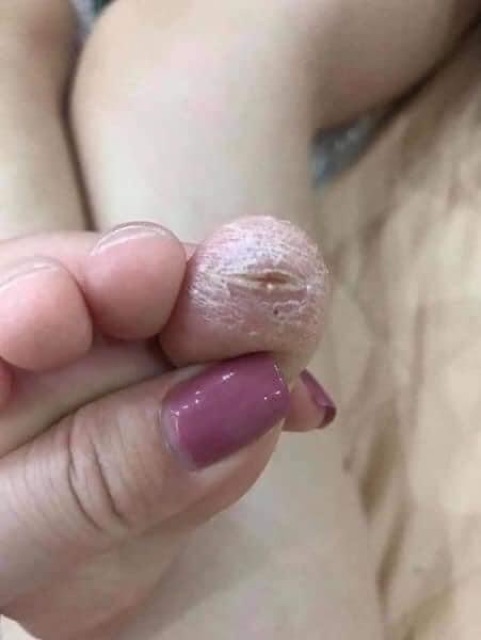 KEM BÔI Á SỪNG
